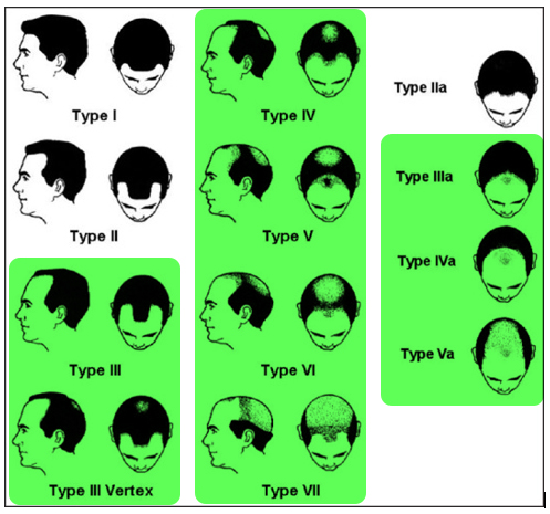 modified Norwood Hamilton Scale